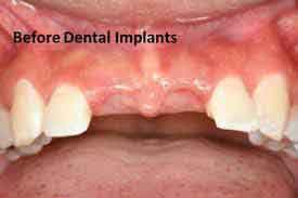 cấy ghép implant có đau không khi đã nhổ răng lâu ngày?