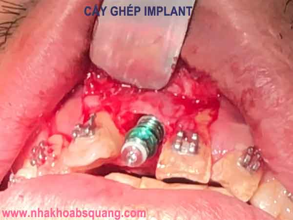 cấy ghép implant có đau không - Nha Khoa Sài BS Quang