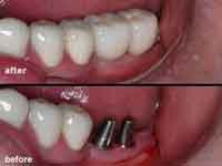 cấy ghép implant hàm dưới có đau không?