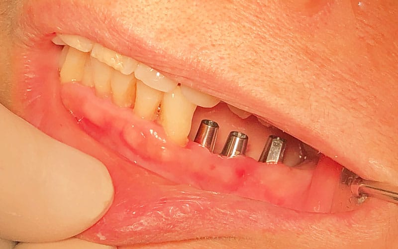 cấy ghép implant là gì-1