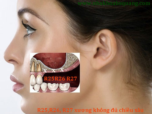 ghép xương trong cấy ghép implant