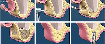 Ghép xương nâng xoang hở trong cấy ghép implant