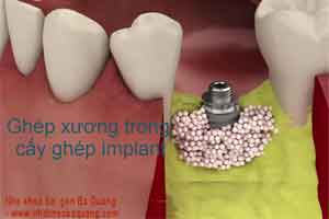 ghép xương nhân tạo trong cấy ghép implant