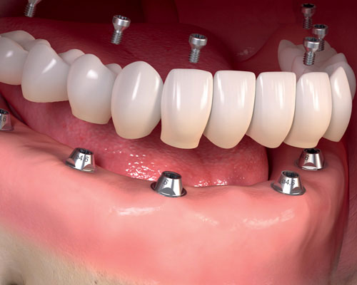 trồng răng bằng cấy ghép implant
