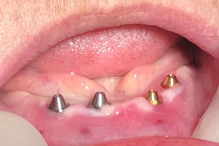 quy trình trồng răng implant all on four nhakhoabsquang