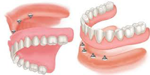 tìm hiểu trồng răng implant