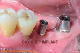 trồng răng nằng phương pháp cấy ghép implant giá bao nhiêu tièn