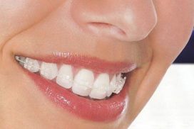 Niềng răng sứ giá bao nhiêu là chuẩn nhất?
