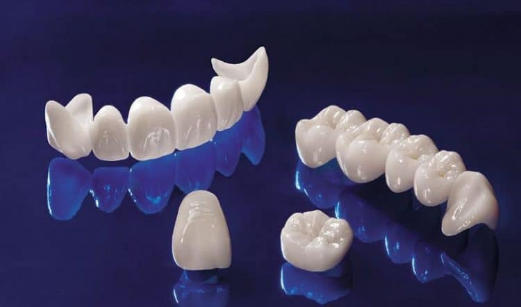 Răng sứ và những vấn đề cần biết về răng sứ?