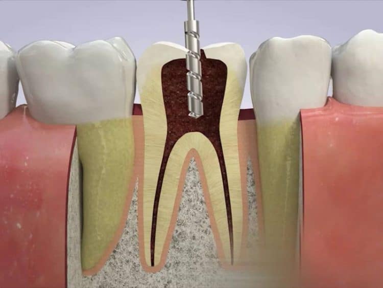 Cách lấy tủy răng nhanh chóng, không đau, nhanh lành?