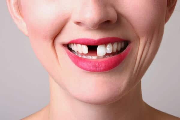 Trồng răng cửa mất khoảng bao lâu, nên trồng loại răng nào?
