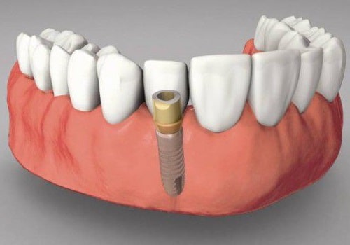 Những điều cần lưu ý khi có ý định trồng răng sứ implant