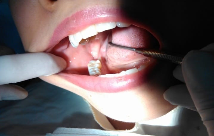 Cách trám răng không bị đau hiện nay tại Nha Khoa Sài Gòn bác sĩ Quang