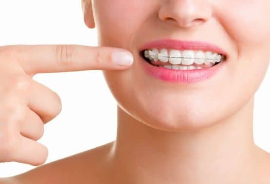 Giá niềng răng rẻ nhất TP.HCM là bao nhiêu?