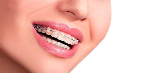 Niềng răng ở đâu tốt giá rẻ chuyên nghiệp?