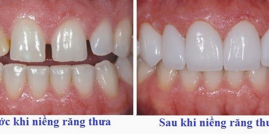 Những điều cần biết khi muốn niềng răng thưa