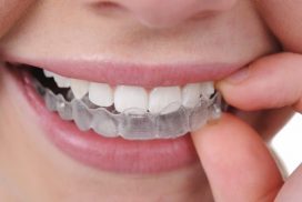 Niềng răng trong suốt là gì, tất tần tật "gói gọn" tại đây