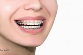 Bảng giá niềng răng 2019 mới nhất tại tphcm hiện nay