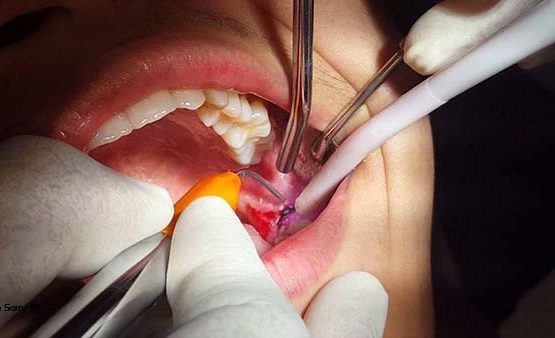 Chi phí nhổ răng khôn hiện nay bao nhiêu?