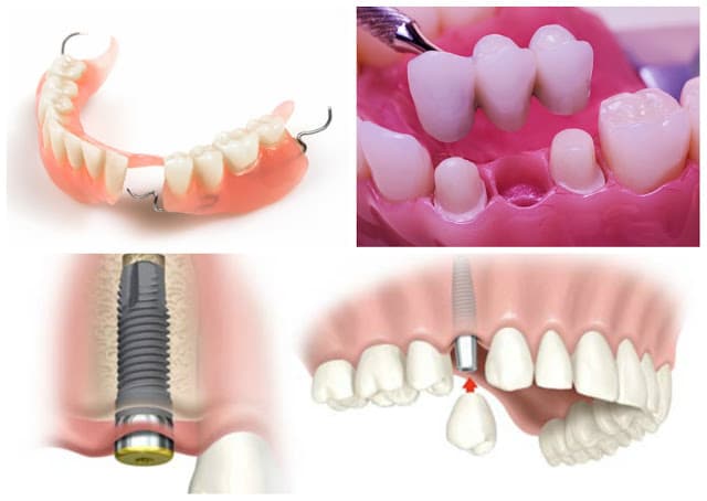 Chi phí trồng răng thực tế vì sao cao hơn bảng giá dịch vụ?