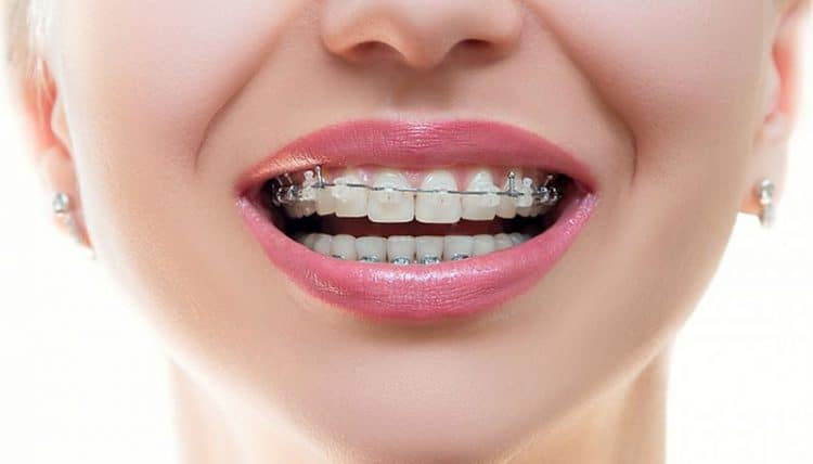 Bác sĩ cho tôi hỏi chi phí niềng răng hiện nay bao nhiêu ạ?