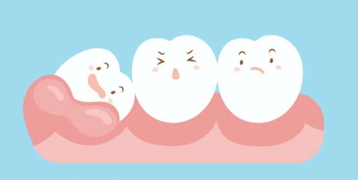 Vì sao nhổ răng khôn giá cao hơn nhổ răng khác?