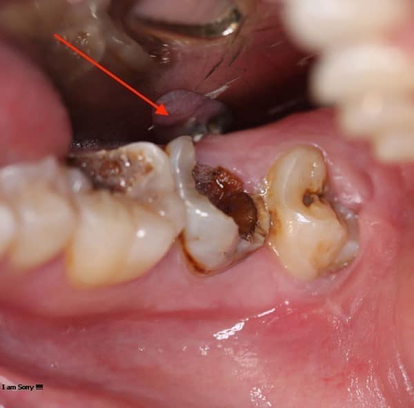 Nhổ răng số 6 có ảnh hưởng đến chức năng nhai, làm sao khắc phục?