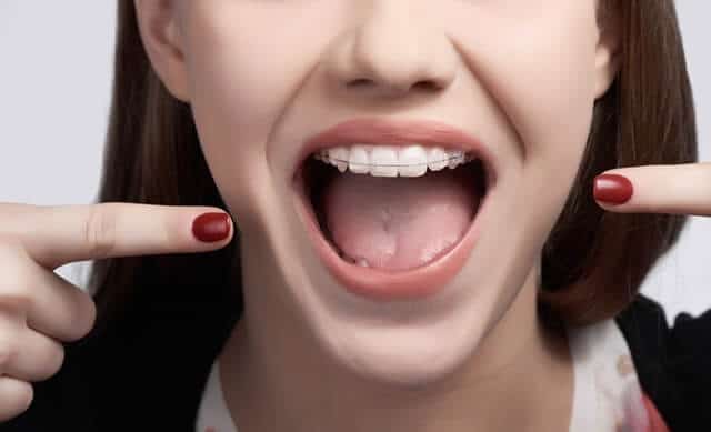 Niềng răng có đau không – Cùng bác sĩ giải đáp?