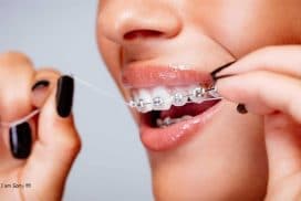 Niềng răng hết bao nhiêu tiền vậy thưa bác sĩ?