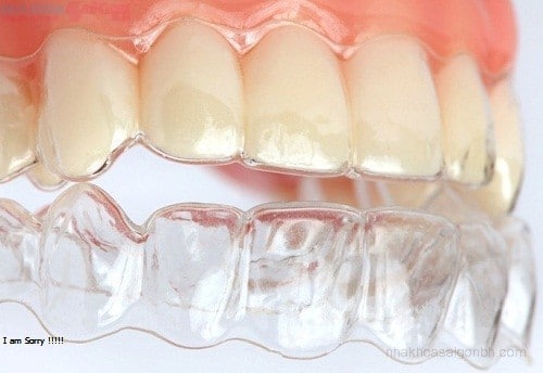 Niềng răng trong suốt giá bao nhiêu, trường hợp nặng có niềng được không?
