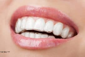 Niềng răng trong suốt giá bao nhiêu, trường hợp nặng có niềng được không?