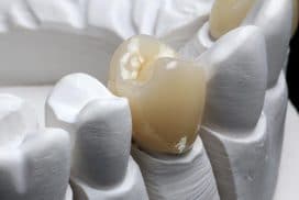 Trồng răng hàm giá bao nhiêu để có được hàm răng vĩnh viễn?