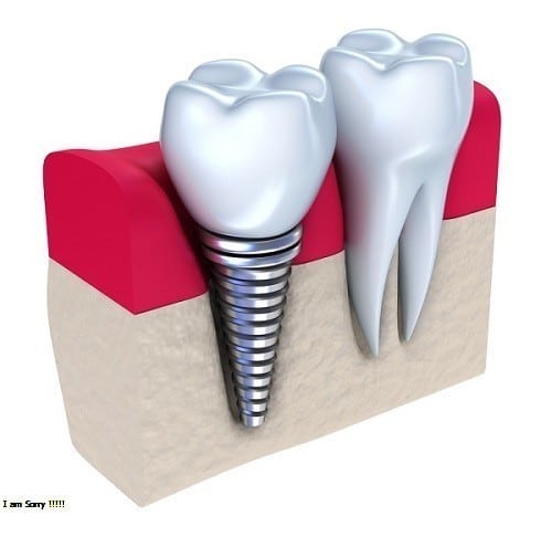 Trồng răng implant ở đâu tốt, vừa tiết kiệm lại vừa an toàn?