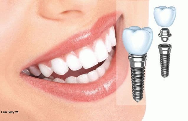 Trồng răng implant ở đâu tốt, vừa tiết kiệm lại vừa an toàn?