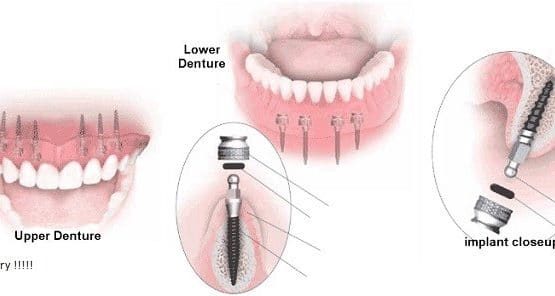 Trồng răng sứ có đau không vậy mọi người?