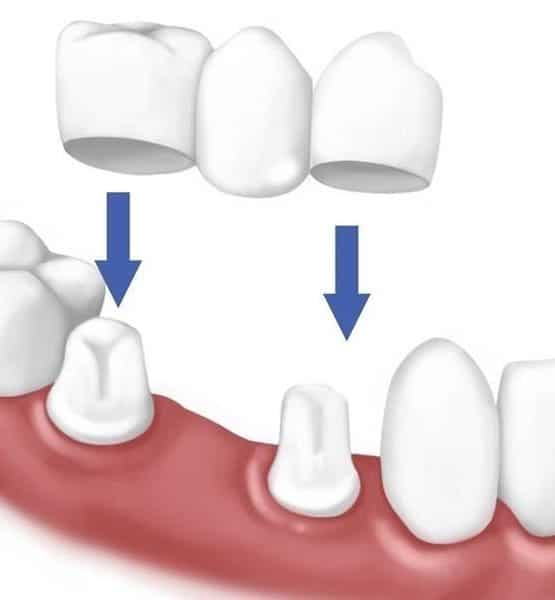 Trồng răng sứ vĩnh viễn giá bao nhiêu?