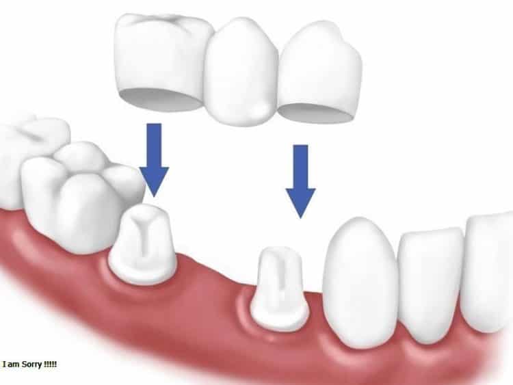 Trồng răng sứ vĩnh viễn giá bao nhiêu?