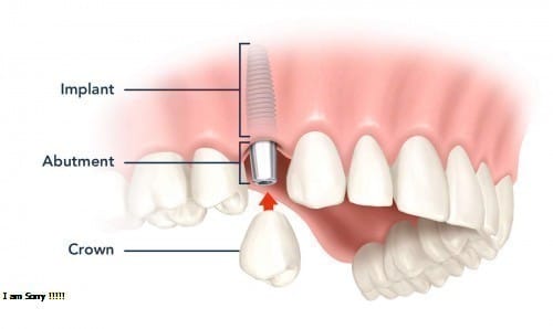 Trồng răng sứ vĩnh viễn giá bao nhiêu?