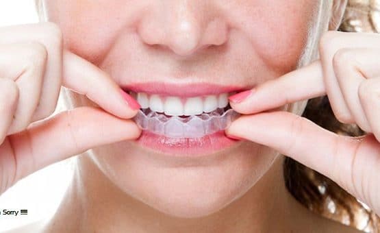 Giá niềng răng trong suốt có đắt không, có những mặt hạn chế nào ạ?