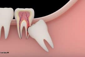 Nên nhổ răng khôn ở đâu giá rẻ, không đau và nhanh lành?