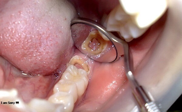 Nhổ răng hàm dưới và những trường hợp cần phải khẩn trương đến nha khoa