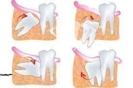 nhổ răng số 8 có ảnh hưởng gì không?