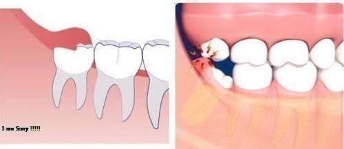 răng khôn có nên nhổ?