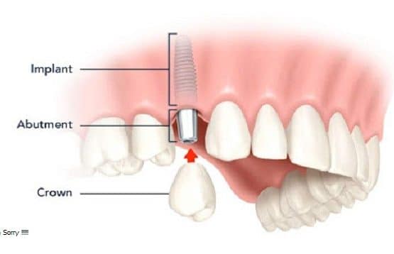 trồng răng cấm bao nhiêu tiền