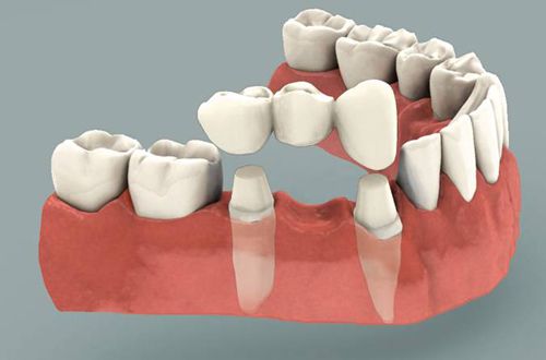 Trồng răng cố định và 4 vấn đề cần nắm rõ trong tầm tay