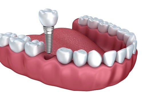 Trồng răng cố định và 4 vấn đề cần nắm rõ trong tầm tay