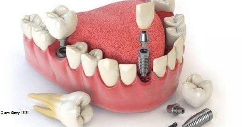 Trồng răng implant bao nhiêu tiền, tôi lớn tuổi rồi có nên trồng không?