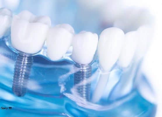 Trồng răng implant bao nhiêu tiền, tôi lớn tuổi rồi có nên trồng không?