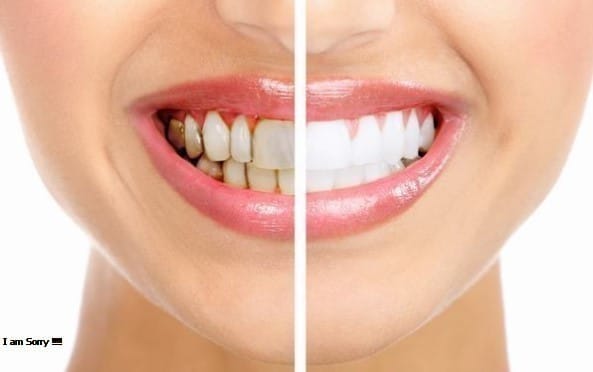 Những "rủi ro" khi trồng răng sứ giá rẻ bạn cần phải biết