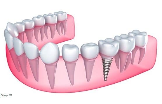 trồng răng sứ vĩnh viễn